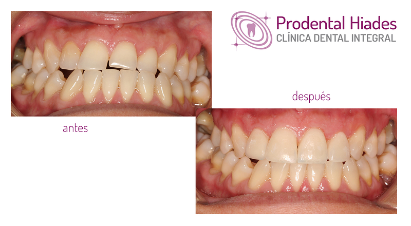 Prodental Hiades 11