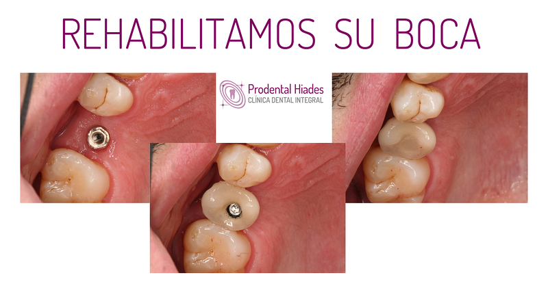 Prodental Hiades 10