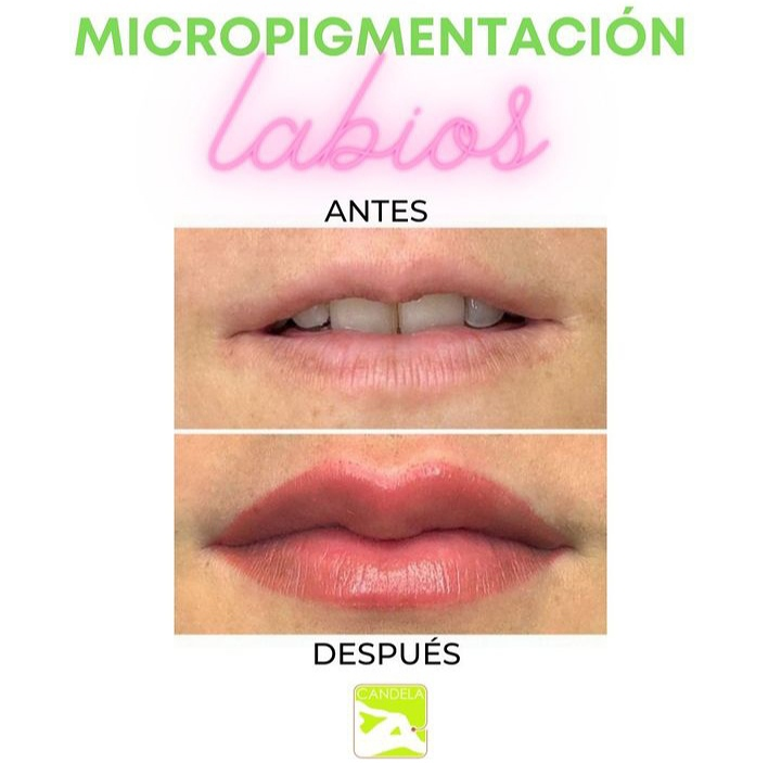 Candela Depilaci&oacute;n Las&eacute;r 6