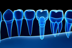 Clínica Dental Indenta Alicante/Alacant Clínica Dental Indenta Alicante/Alacant