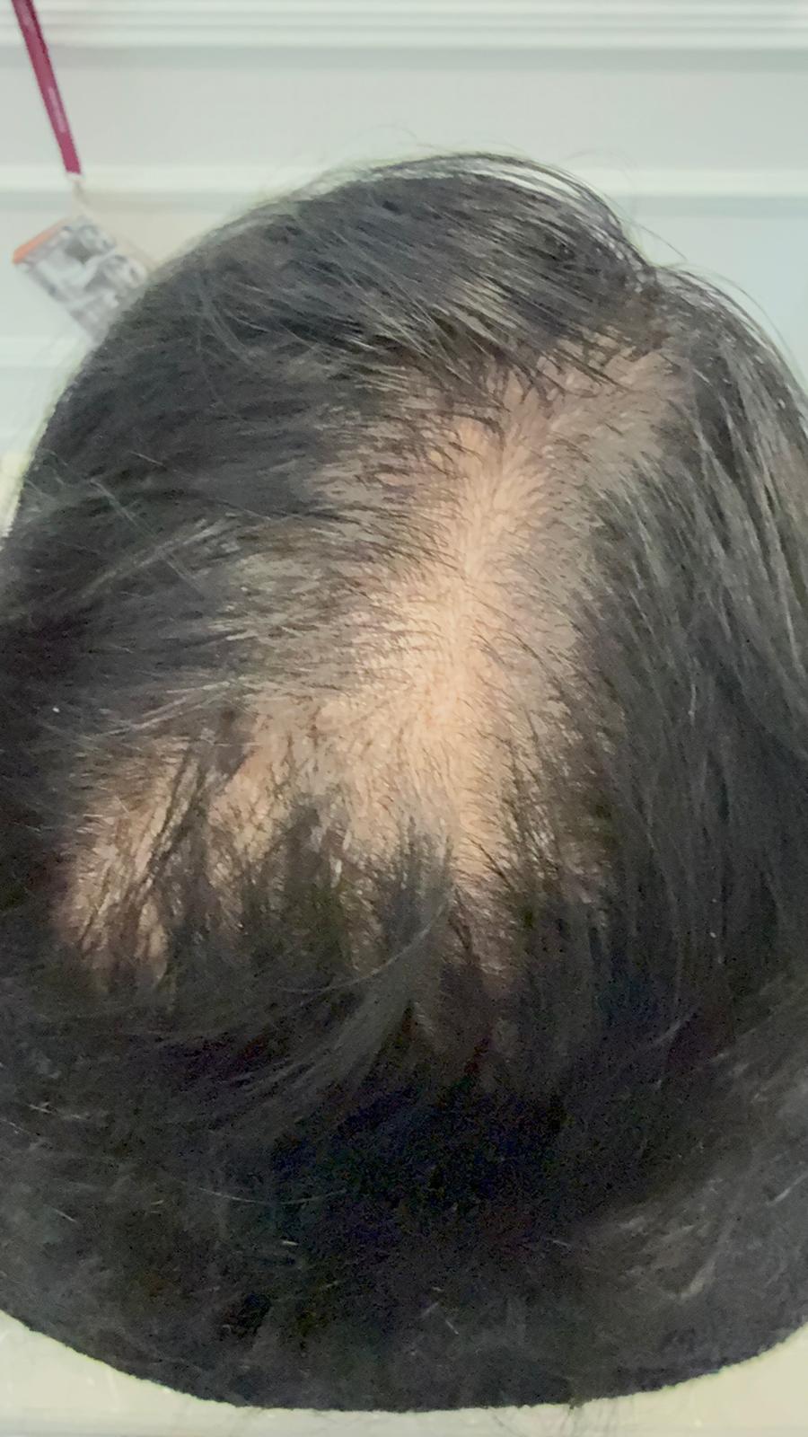 ProCapilHair 6