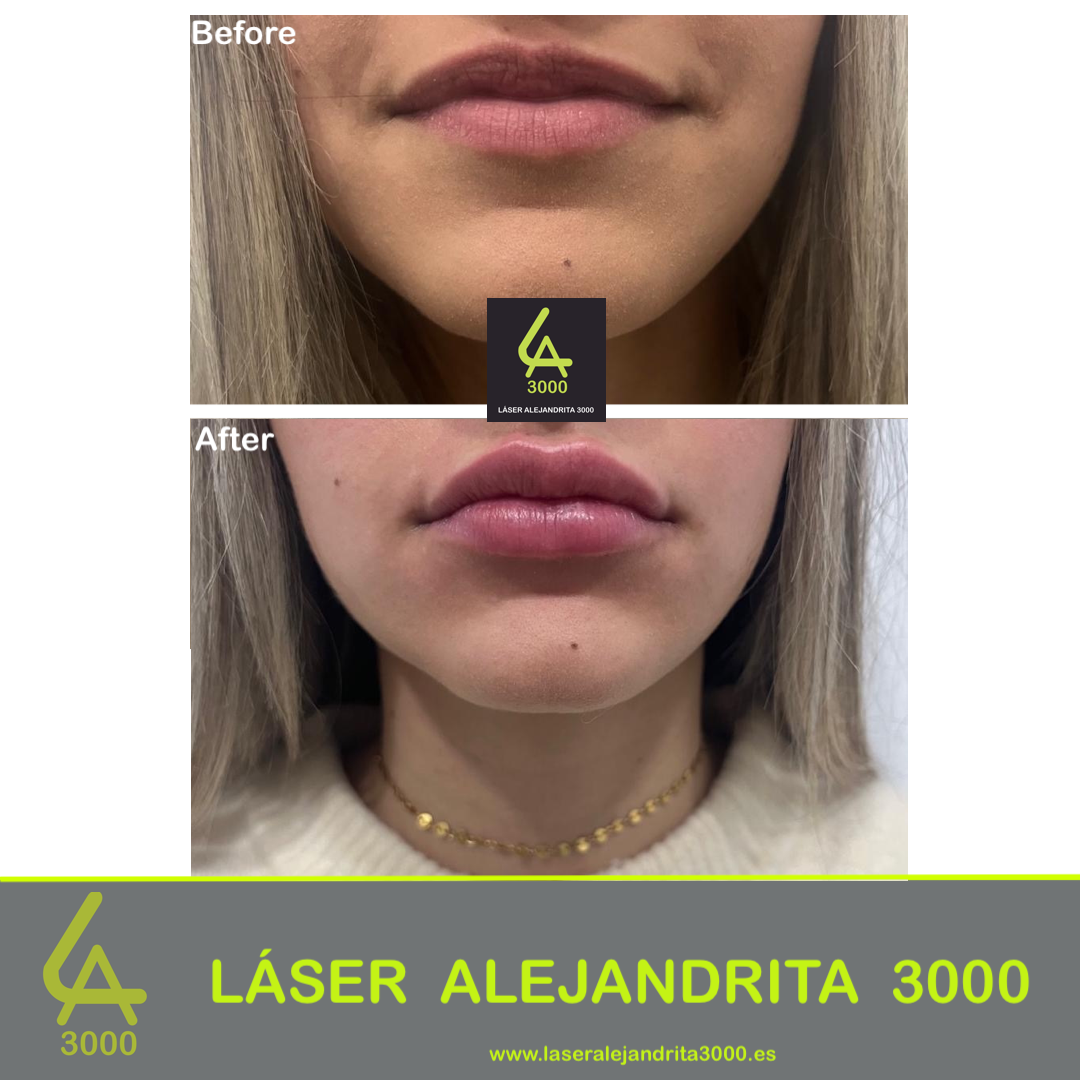 Láser Alejandrita 3000, Depilación Láser y Medicina Estética 25