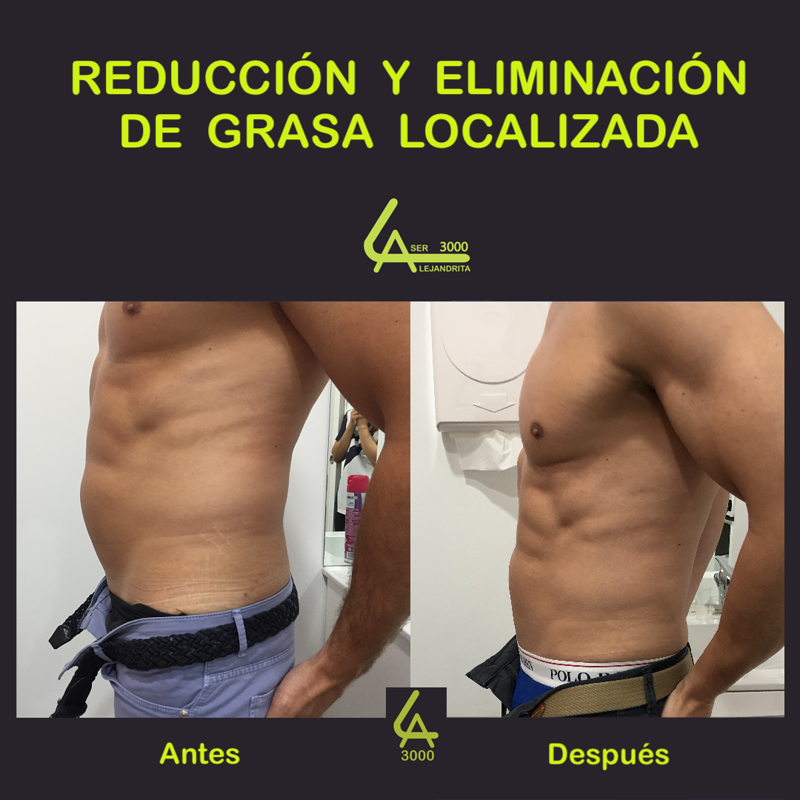 Láser Alejandrita 3000, Depilación Láser y Medicina Estética 12