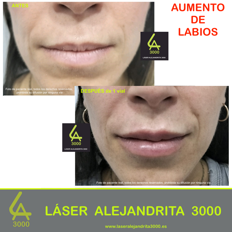 Láser Alejandrita 3000, Depilación Láser y Medicina Estética 27