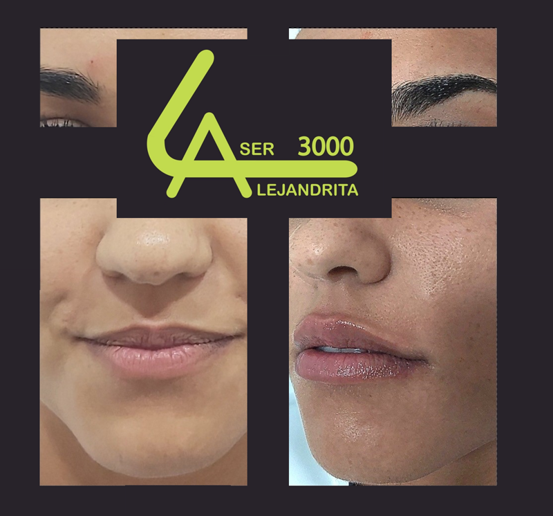 Láser Alejandrita 3000, Depilación Láser y Medicina Estética 14