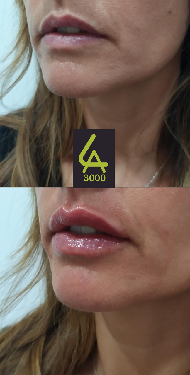 Láser Alejandrita 3000, Depilación Láser y Medicina Estética 15