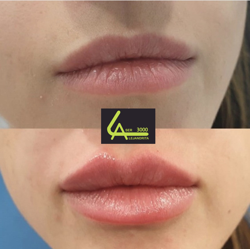 Láser Alejandrita 3000, Depilación Láser y Medicina Estética 13