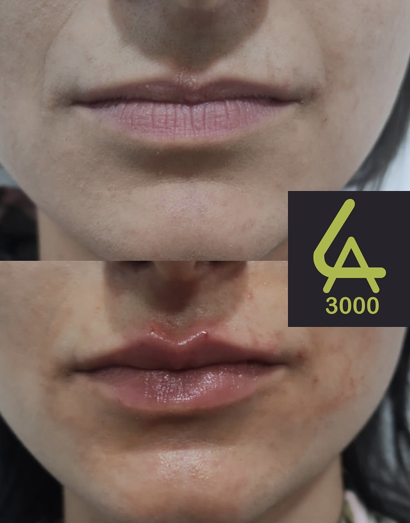 Láser Alejandrita 3000, Depilación Láser y Medicina Estética 9