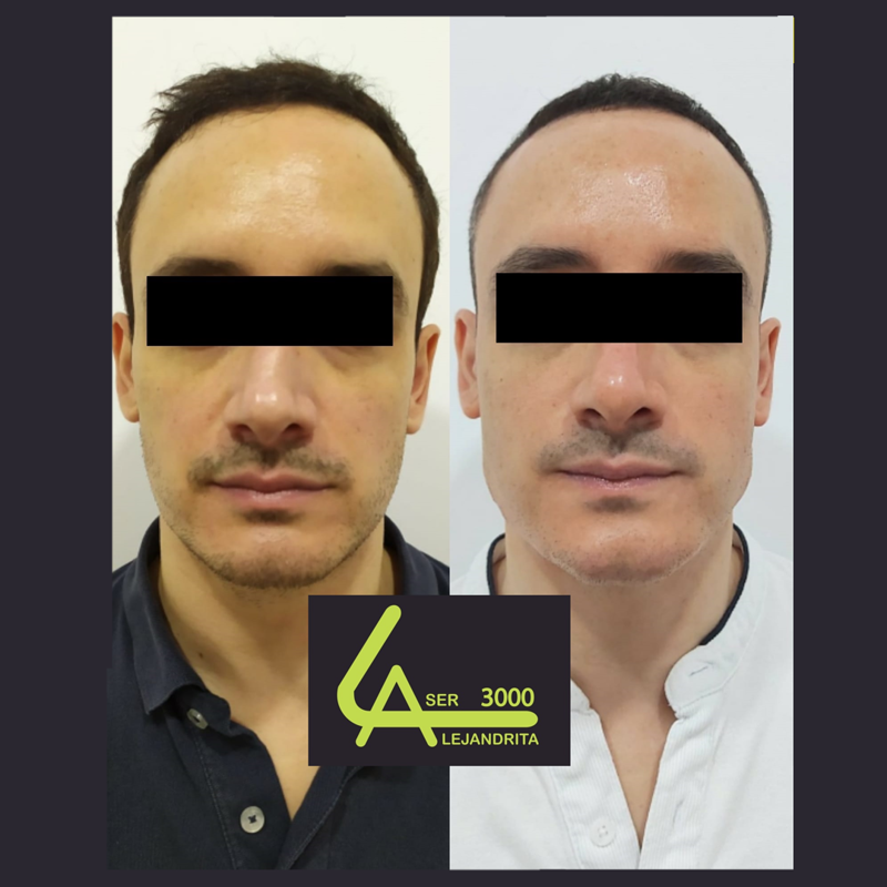 Láser Alejandrita 3000, Depilación Láser y Medicina Estética 20