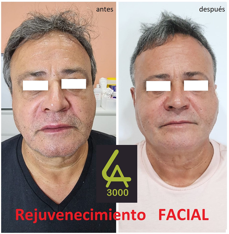 Láser Alejandrita 3000, Depilación Láser y Medicina Estética 10