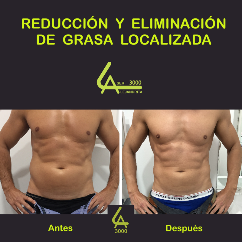 Láser Alejandrita 3000, Depilación Láser y Medicina Estética 11