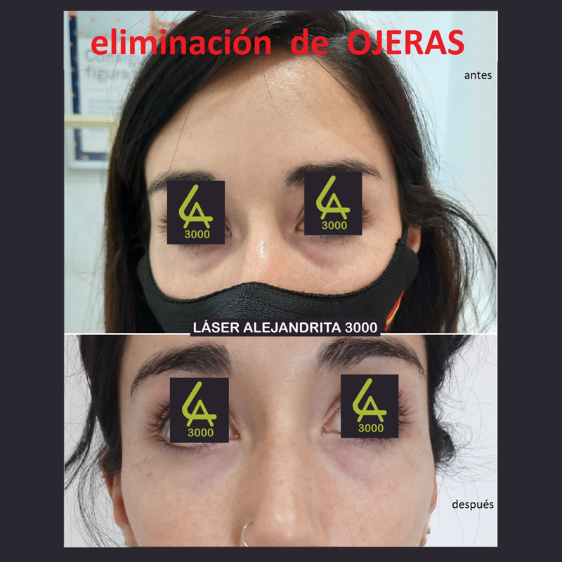 Láser Alejandrita 3000, Depilación Láser y Medicina Estética 19