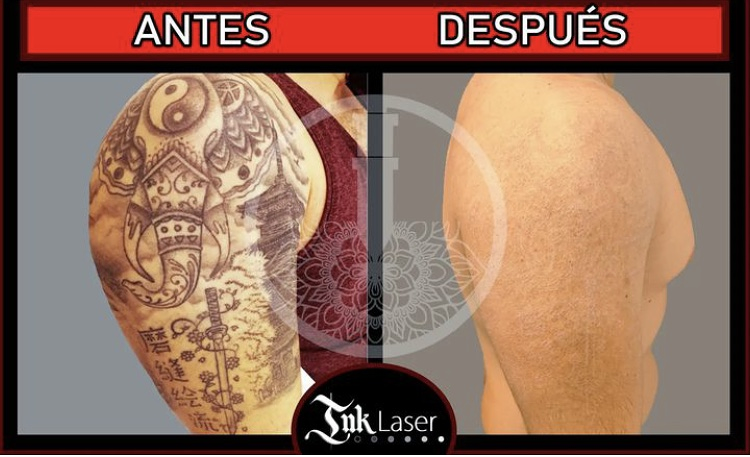 Ink Laser "Eliminar Tatuajes Alicante" ESTETICA: CENTROS