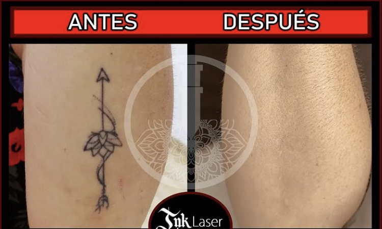 Ink Laser "Eliminar Tatuajes Alicante" Alacant/Alicante