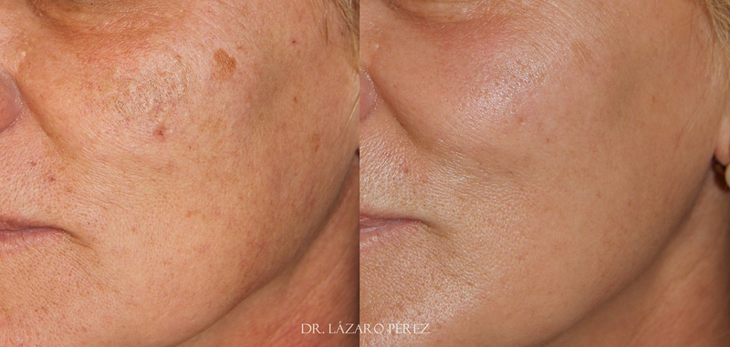 Rahel Laser Klinika Aranda de Duero