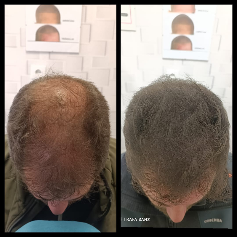 Micropigmentacion Capilar Sanz. Micropigmentacion Capilar En Cordoba y en Jaen. 10