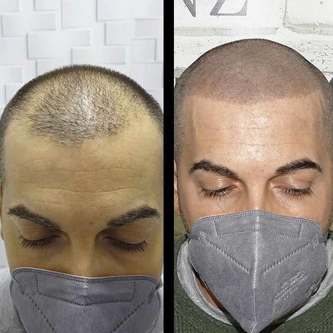 Micropigmentacion Capilar Sanz. Micropigmentacion Capilar En Cordoba y en Jaen. MICROPIGMENTACION (MAQUILLAJE PERMANENTE): SERVICIOS