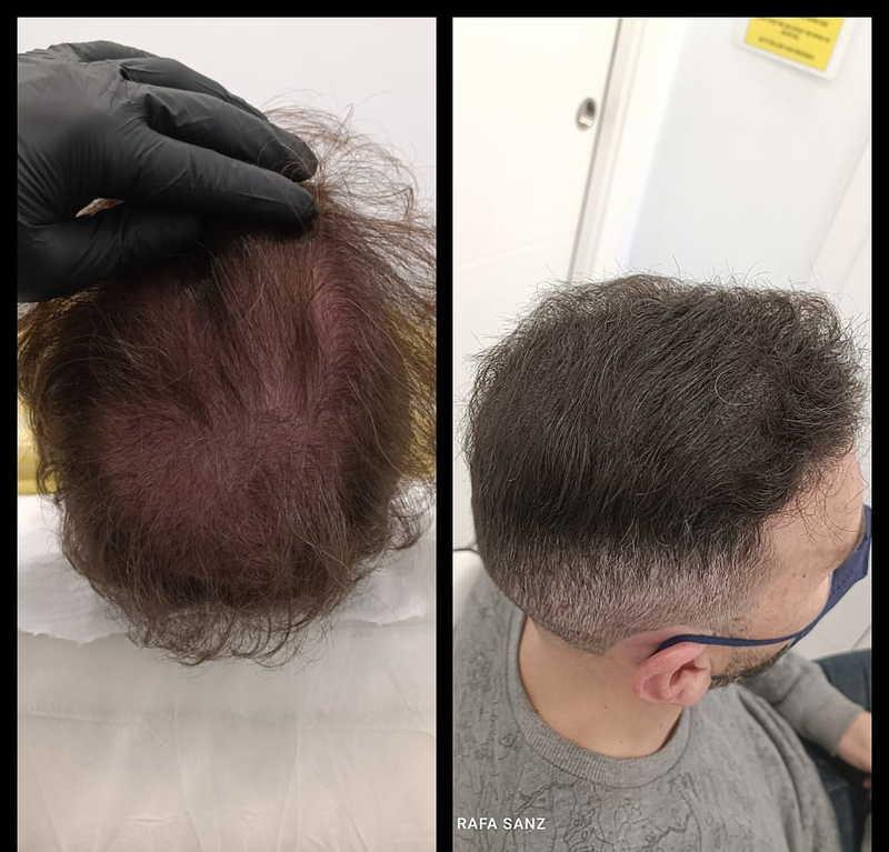 Micropigmentacion Capilar Sanz. Micropigmentacion Capilar En Cordoba y en Jaen. 6