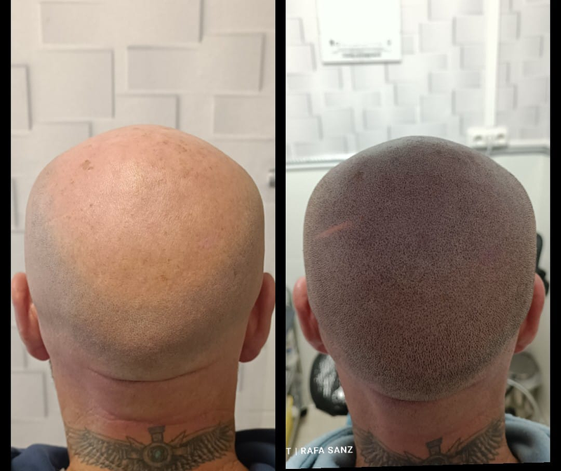 Micropigmentacion Capilar Sanz. Micropigmentacion Capilar En Cordoba y en Jaen. 5