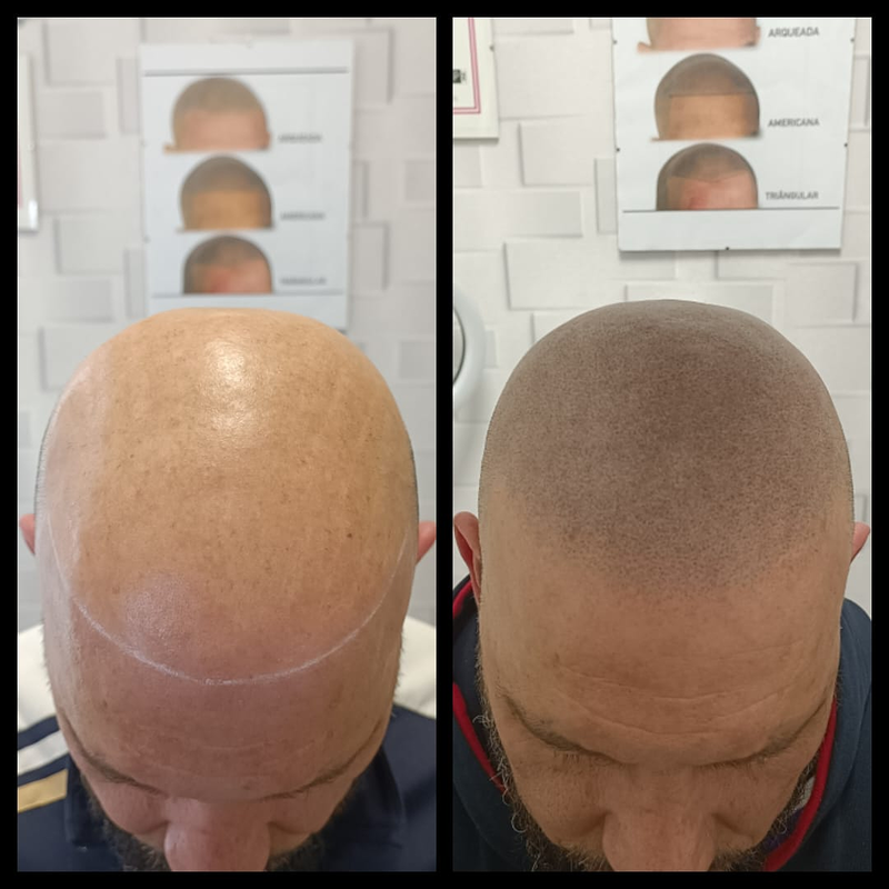 Micropigmentacion Capilar Sanz. Micropigmentacion Capilar En Cordoba y en Jaen. 7