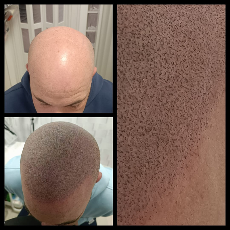 Micropigmentacion Capilar Sanz. Micropigmentacion Capilar En Cordoba y en Jaen. 11