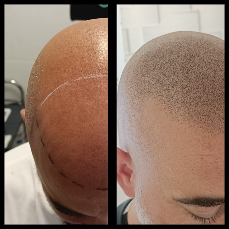 Micropigmentacion Capilar Sanz. Micropigmentacion Capilar En Cordoba y en Jaen. 8