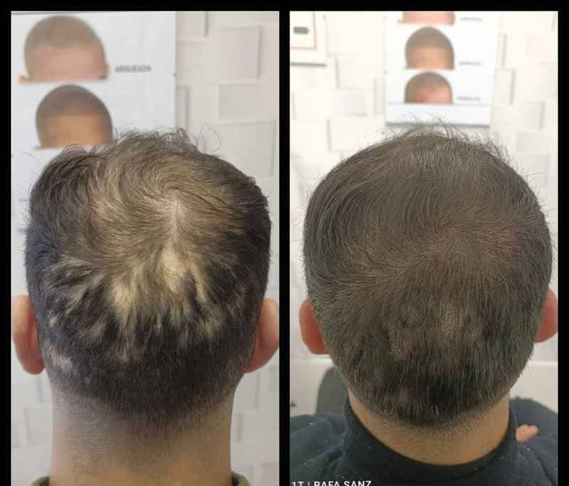 Micropigmentacion Capilar Sanz. Micropigmentacion Capilar En Cordoba y en Jaen. 4