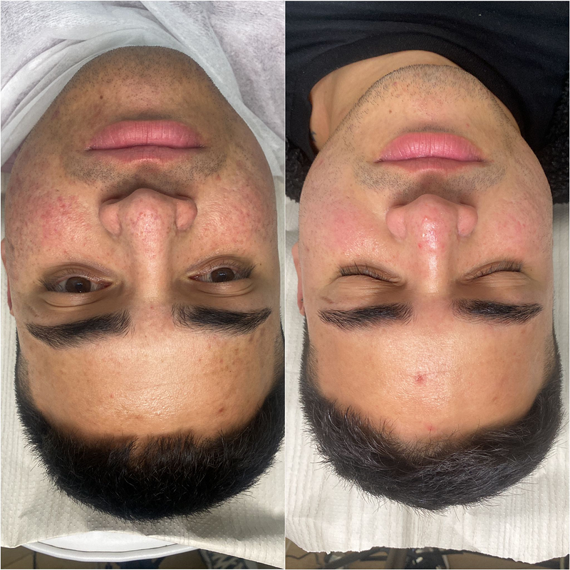 Microblading Barcelona - Micropigmentaci&oacute;n Barcelona - Hely Poveda 5