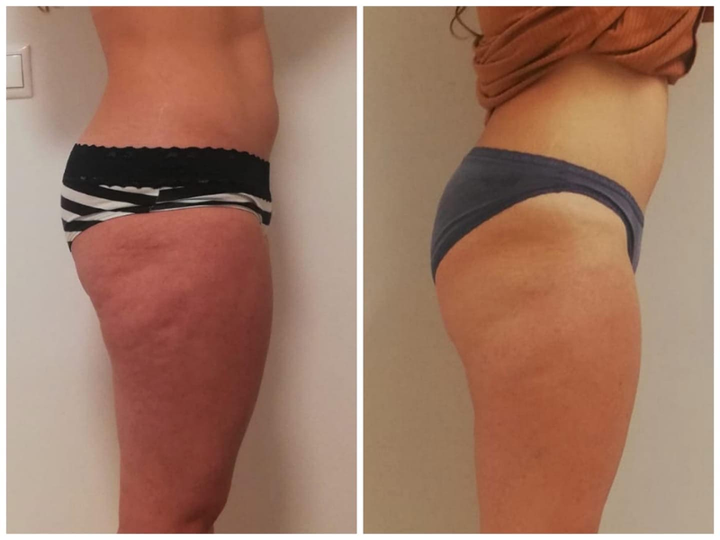 Centro De Est&eacute;tica Avanzada En San Juan Alicante- Kemana 6