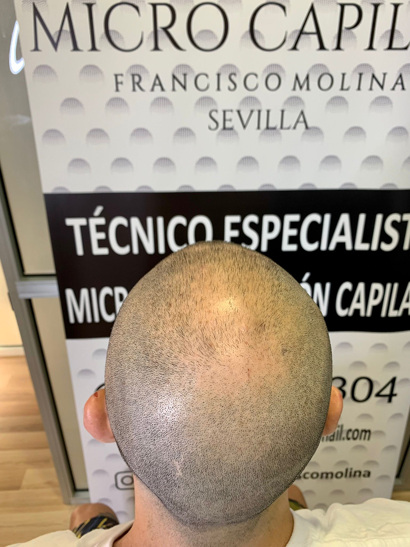 Micro Capilar Francisco Molina 5
