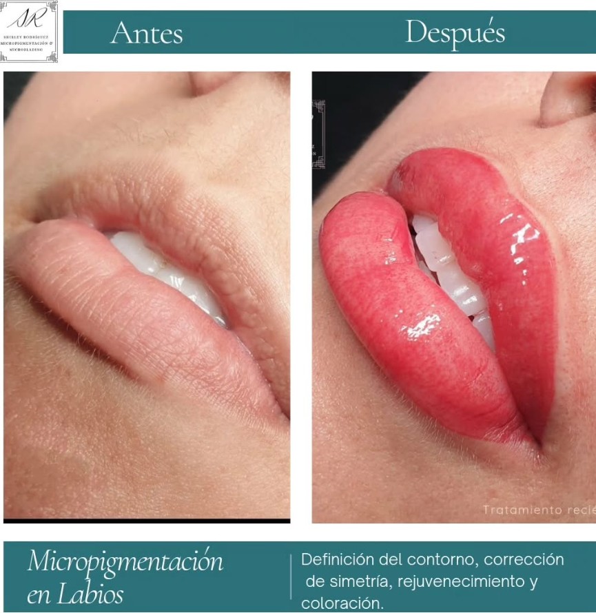 Dermitl&aacute;ser 6