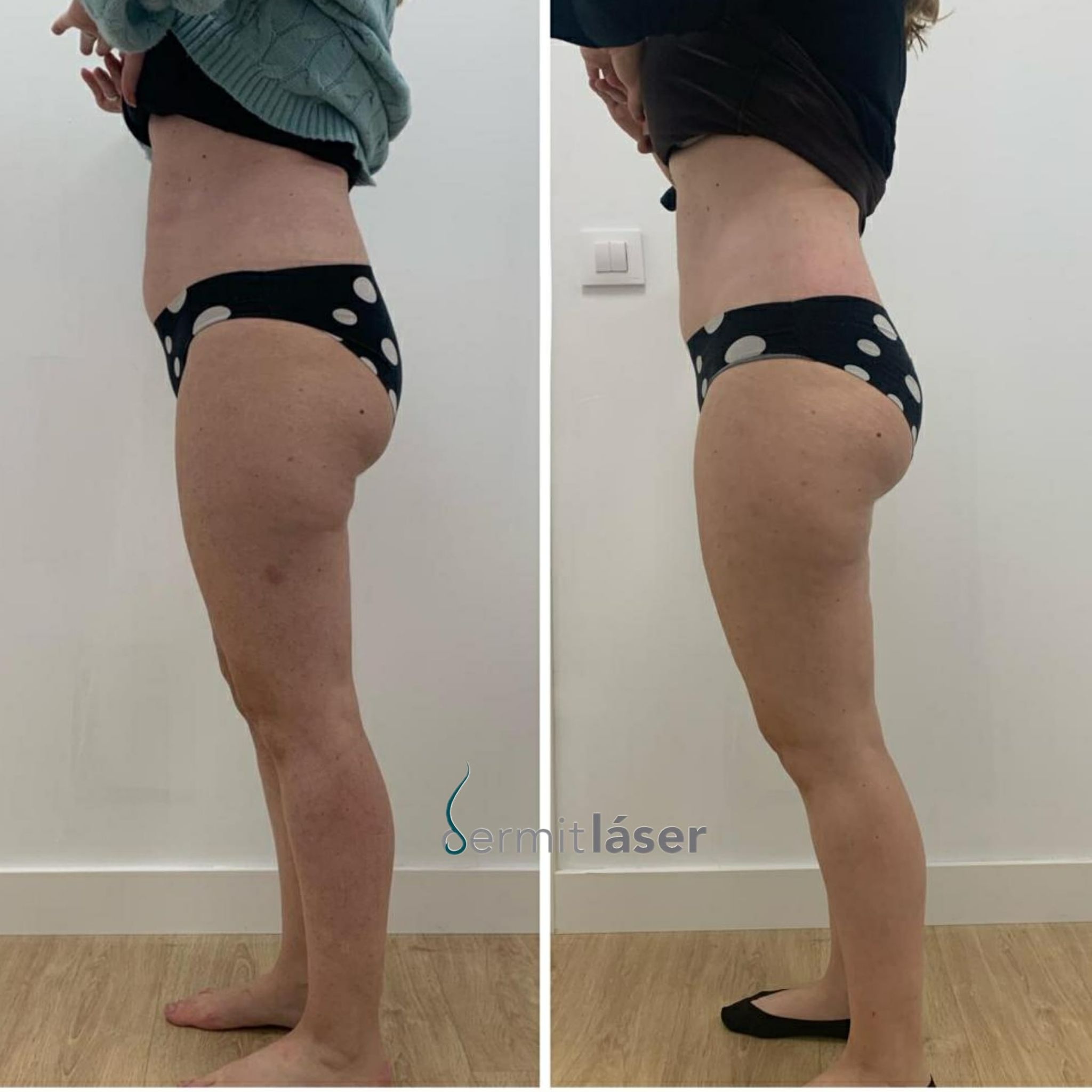 Dermitl&aacute;ser 7