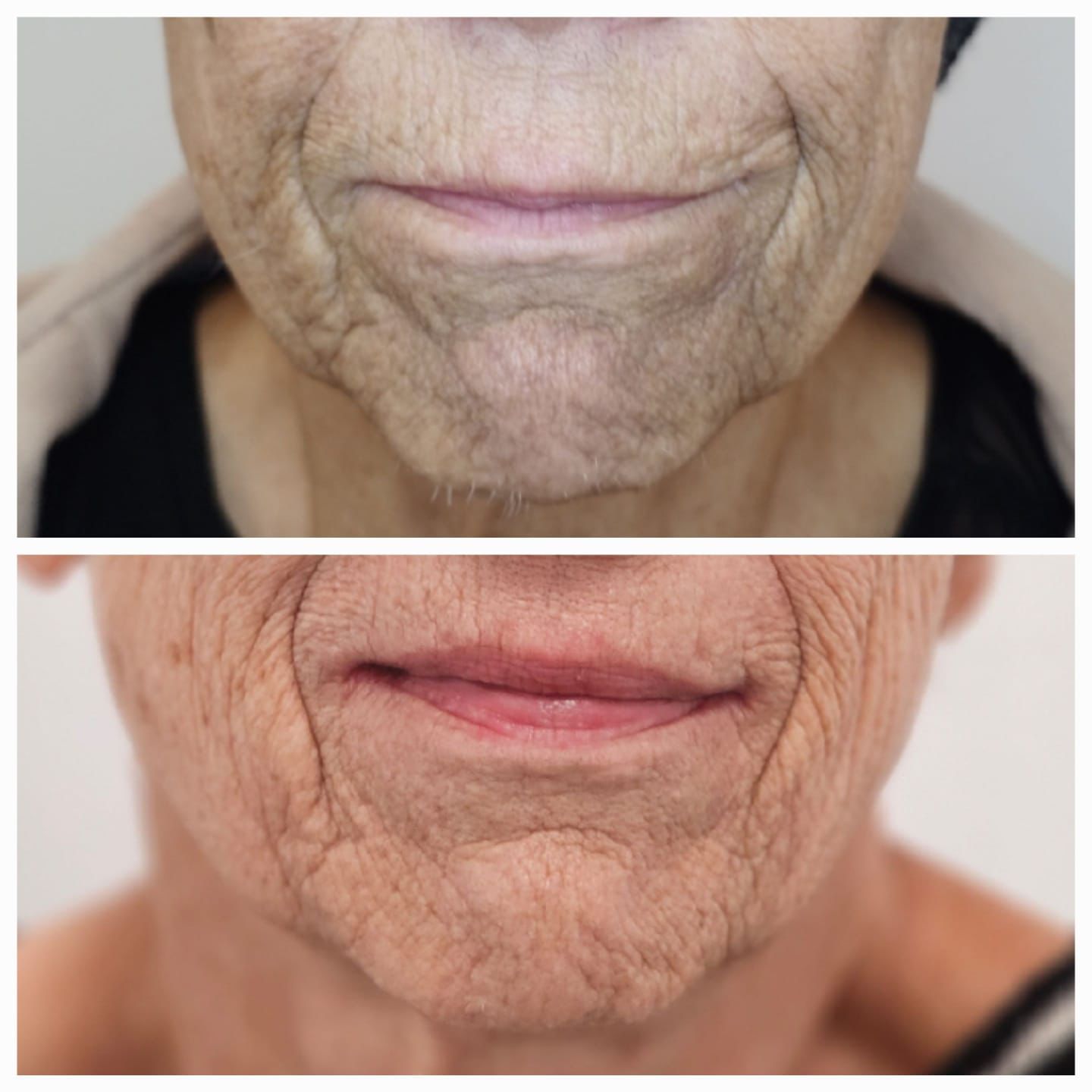 Dermitl&aacute;ser 4