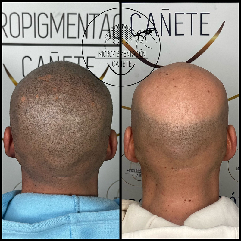 Micropigmentacion Capilar Cañete. Micropigmentación Capilar en Córdoba. 8