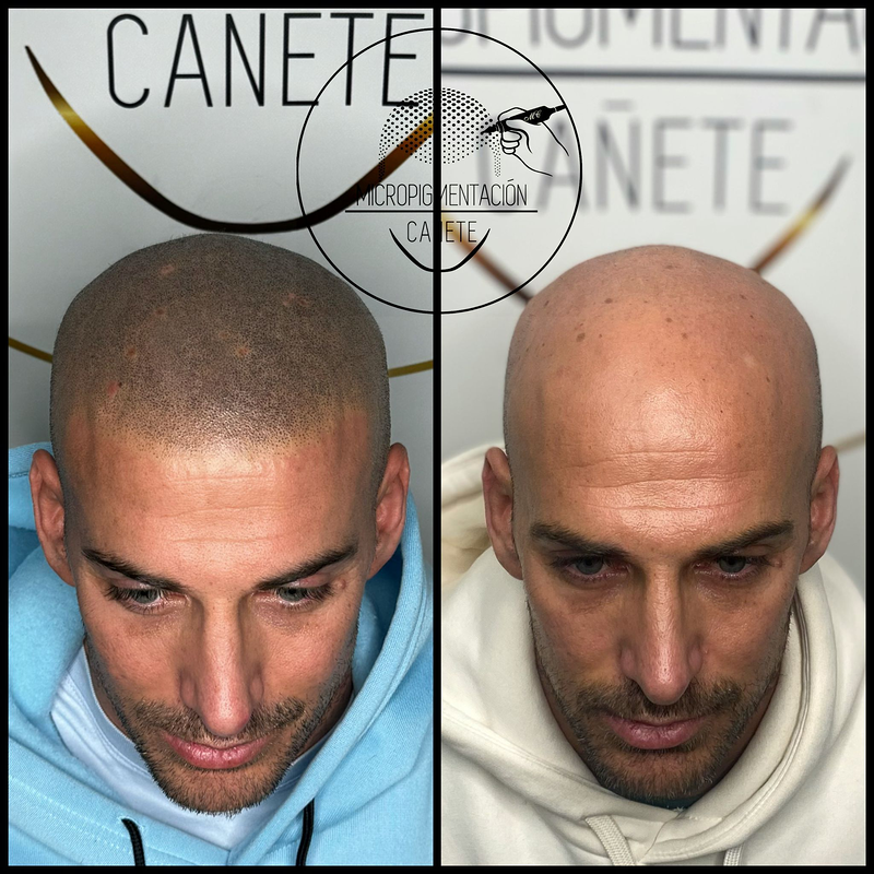 Micropigmentacion Capilar Cañete. Micropigmentación Capilar en Córdoba. 7