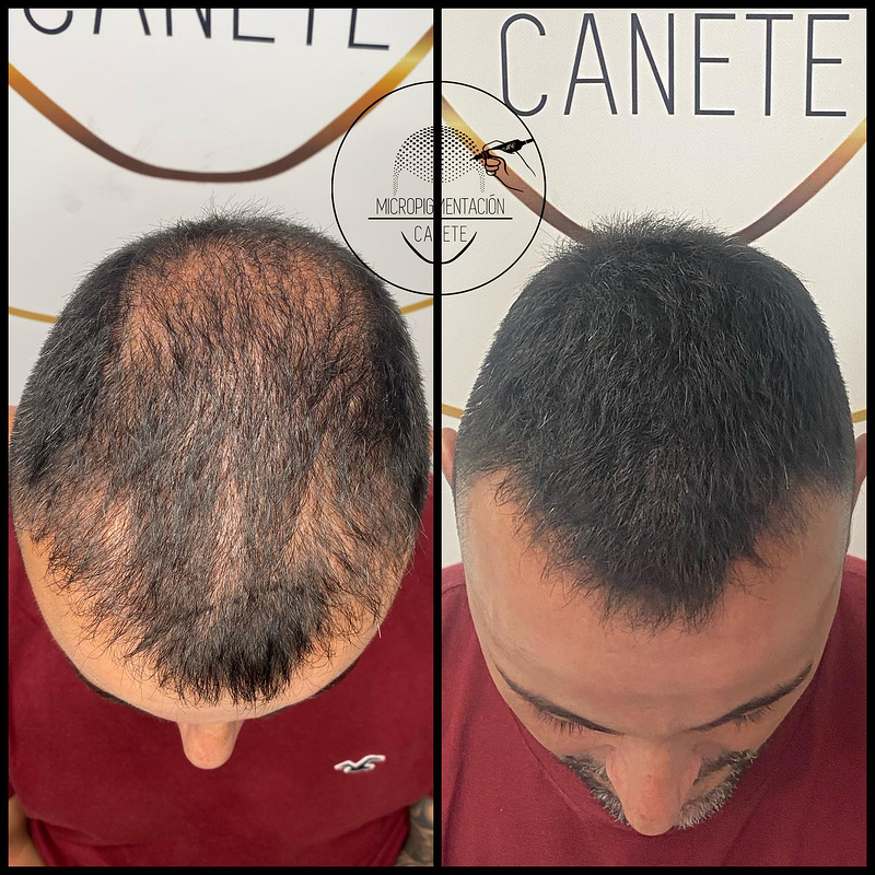 Micropigmentacion Capilar Cañete. Micropigmentación Capilar en Córdoba. MICROPIGMENTACION (MAQUILLAJE PERMANENTE): SERVICIOS