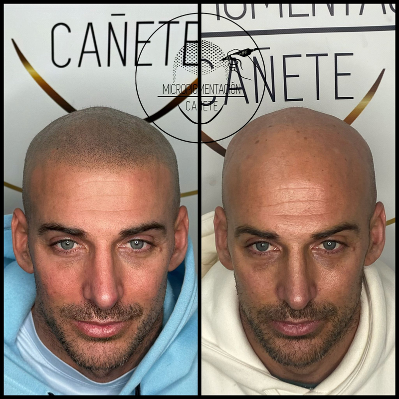 Micropigmentacion Capilar Cañete. Micropigmentación Capilar en Córdoba. 9