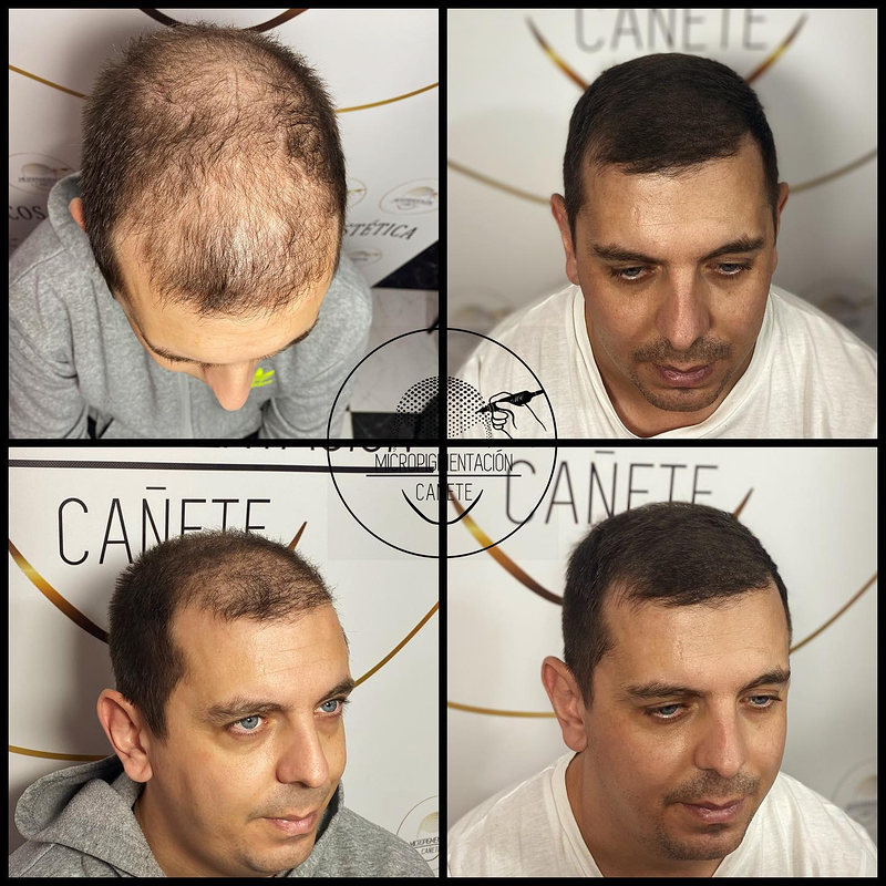 Micropigmentacion Capilar Cañete. Micropigmentación Capilar en Córdoba. Nueva Carteya