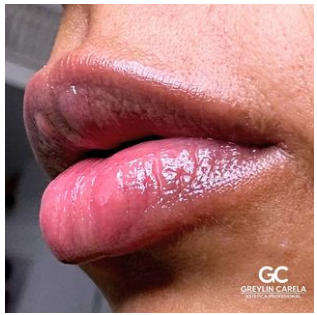 Greylin Carela Est&eacute;tica Profesional 4