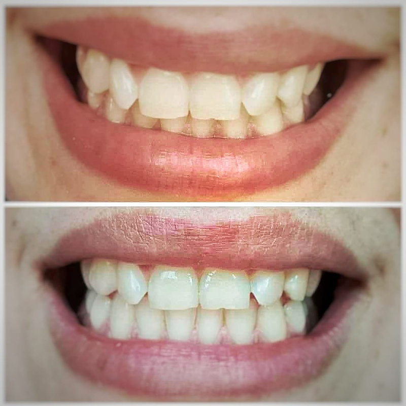 Fv Láser Nails Beauty 33