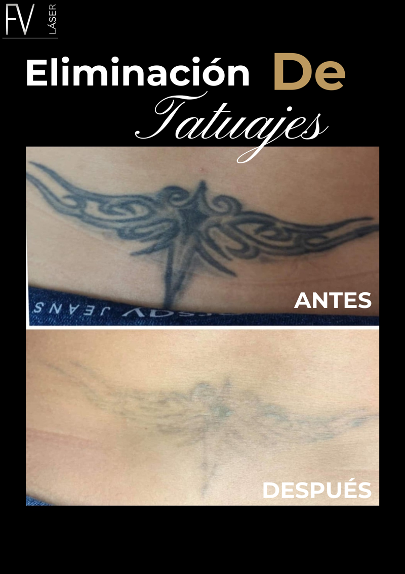 Fv Láser Nails Beauty 14