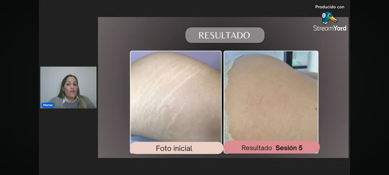 Fv Láser Nails Beauty 52