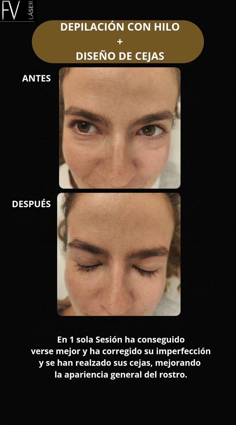 Fv Láser Nails Beauty 19