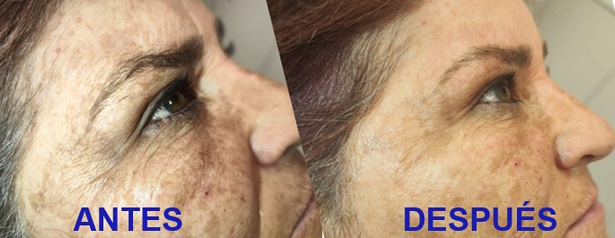 Fv Láser Nails Beauty 62