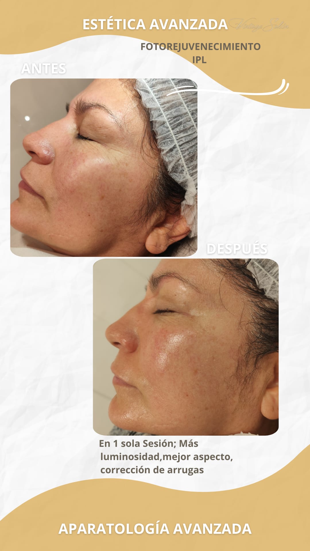 Fv Láser Nails Beauty 64