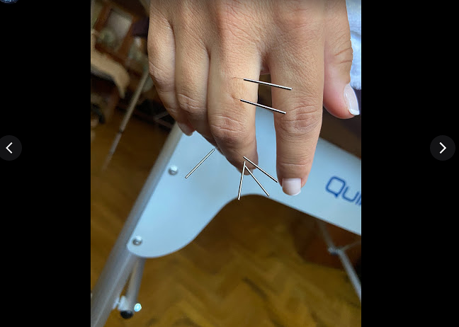 Acupuntura Avanzada Madrid Madrid