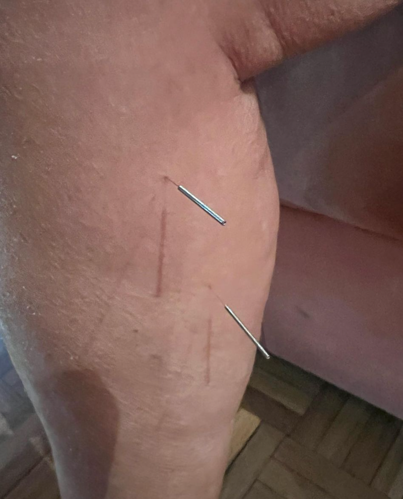 Acupuntura Avanzada Madrid 16