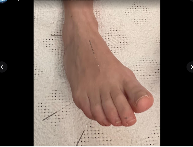 Acupuntura Avanzada Madrid 4