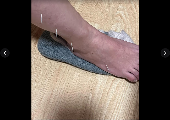 Acupuntura Avanzada Madrid 3