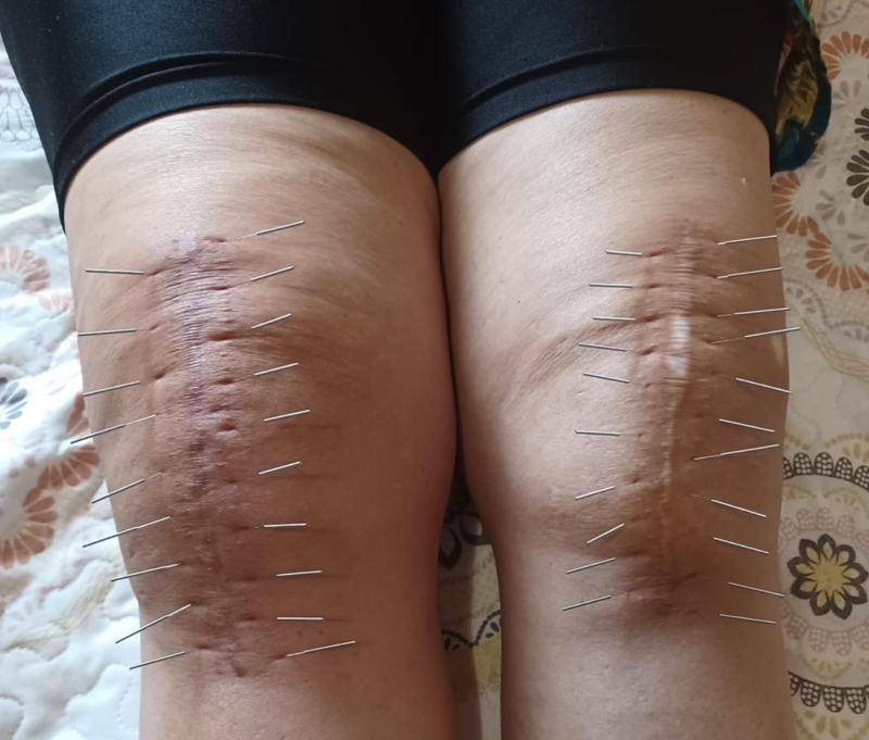 Acupuntura Avanzada Madrid 17